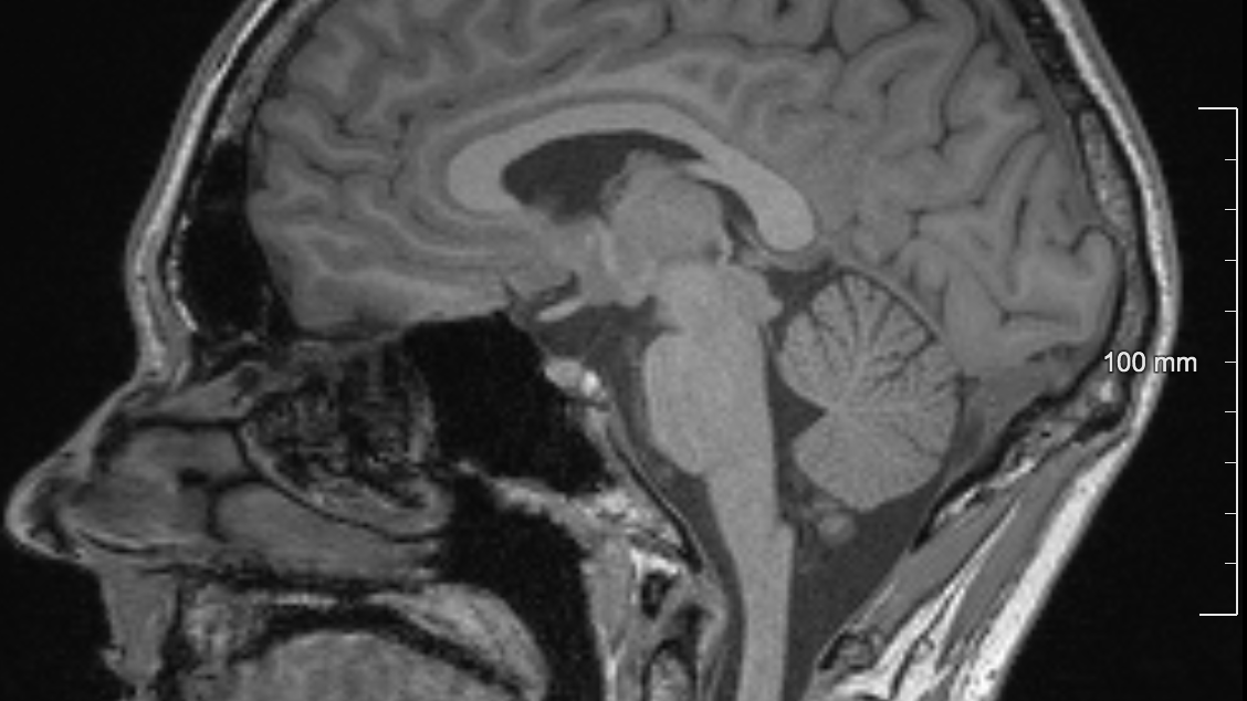 Dieses Bild zeigt eine Schwarz-Weiß Aufnahme eines menschlichen Gehirns mitsamt Schädel.